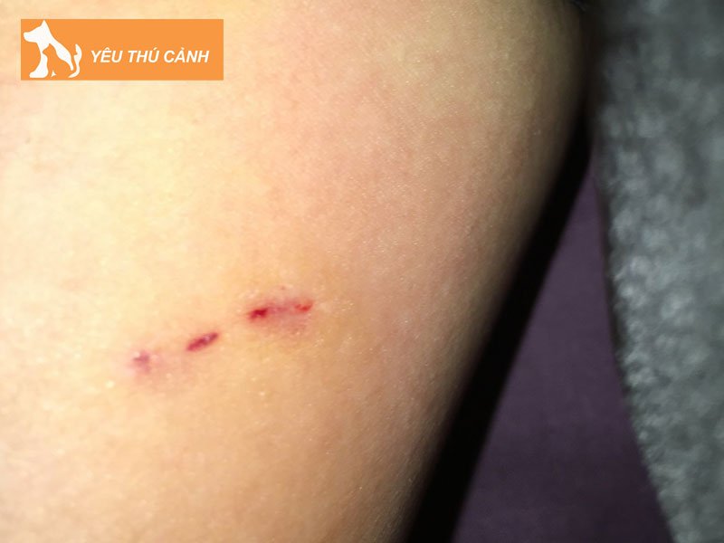 bi-ret-can-co-sao-khong-nhung-bieu-hien-thuong-gap-thucanh