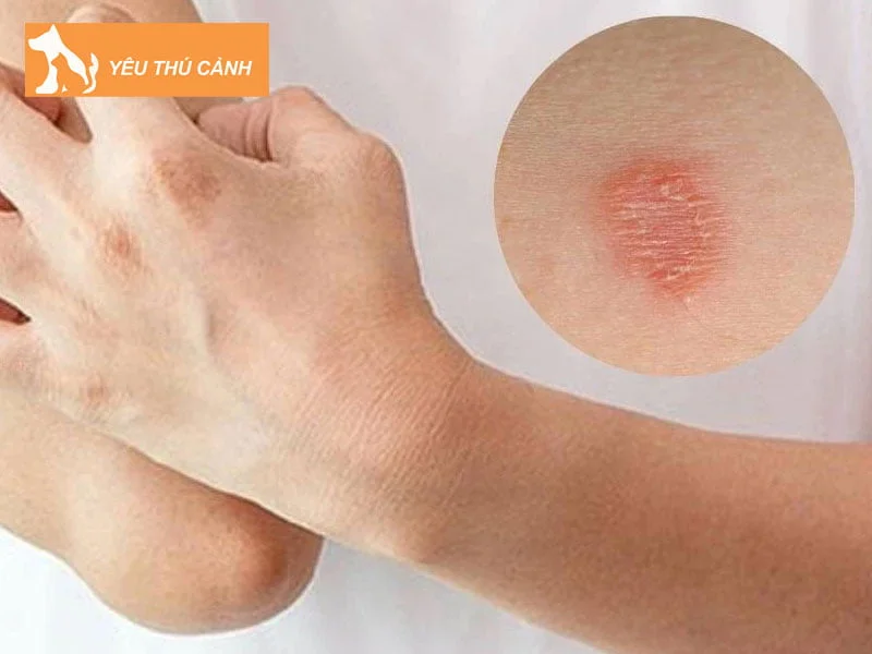 cach-chua-tri-benh-nam-meo-o-nguoi-1-thucanh