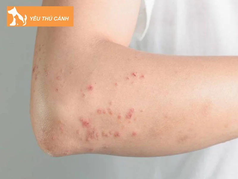 cach-chua-tri-benh-nam-meo-o-nguoi-2-thucanh