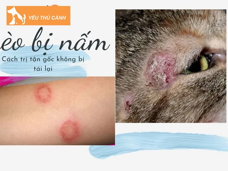 cach-chua-tri-benh-nam-meo-o-nguoi-thucanh