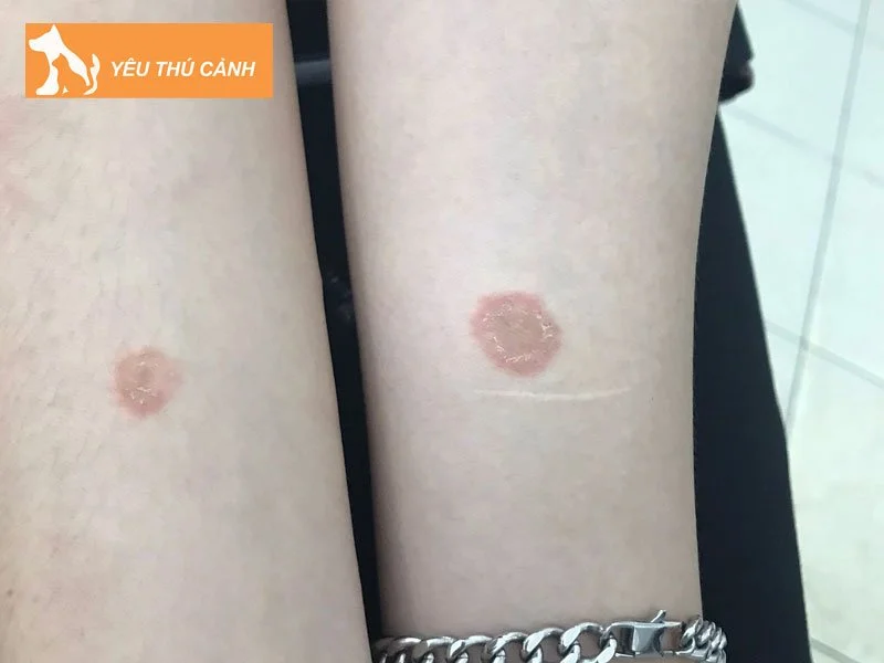 dau-hieu-bi-benh-nam-meo-o-nguoi-thucanh